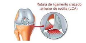 ligamento